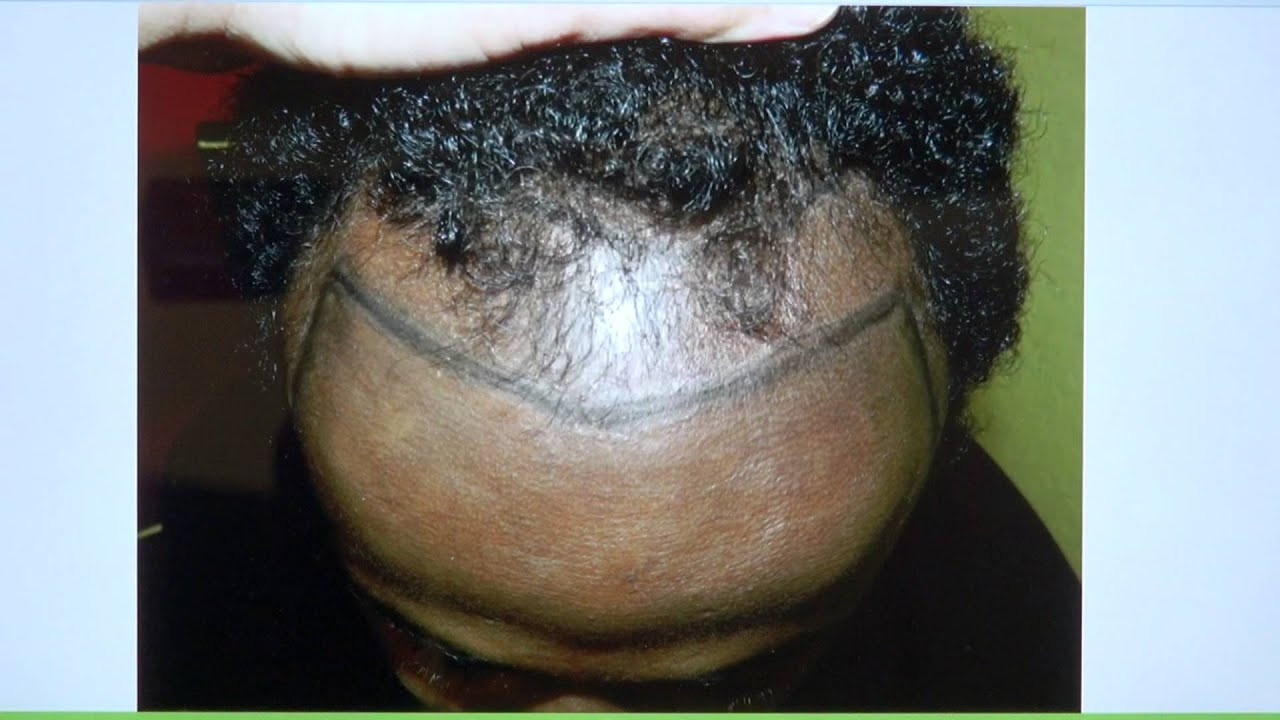 Black Male Receding Hairline Haircuts
 Black African Man Receding Hairline Hair Transplant Result