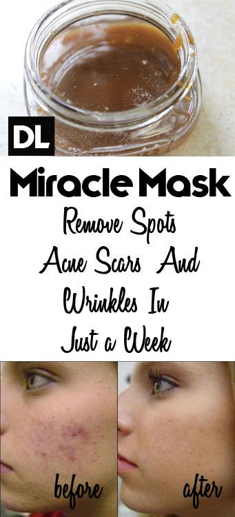 DIY Face Mask To Get Rid Of Acne
 Homemade Face Mask to Get Rid of Spots Acne Scars and
