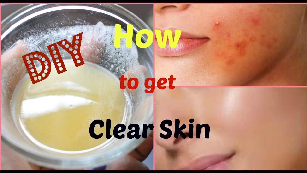 DIY Face Mask To Get Rid Of Acne
 DIY Face Mask to Get Rid of Acne & Acne Scars FAST