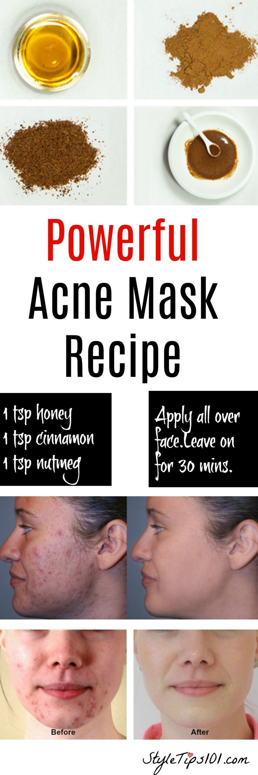 DIY Face Mask To Get Rid Of Acne
 Homemade Natural Acne Mask
