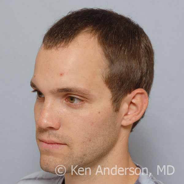 Mens Haircuts Atlanta
 Case 1 Anderson Center for Hair in Alpharetta & Atlanta GA