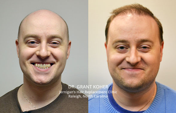 Mens Haircuts Raleigh
 Koher Surgical Hair Transplants Dr Grant Koher Hair